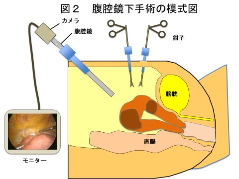 図2　腹腔鏡下手術の模式図